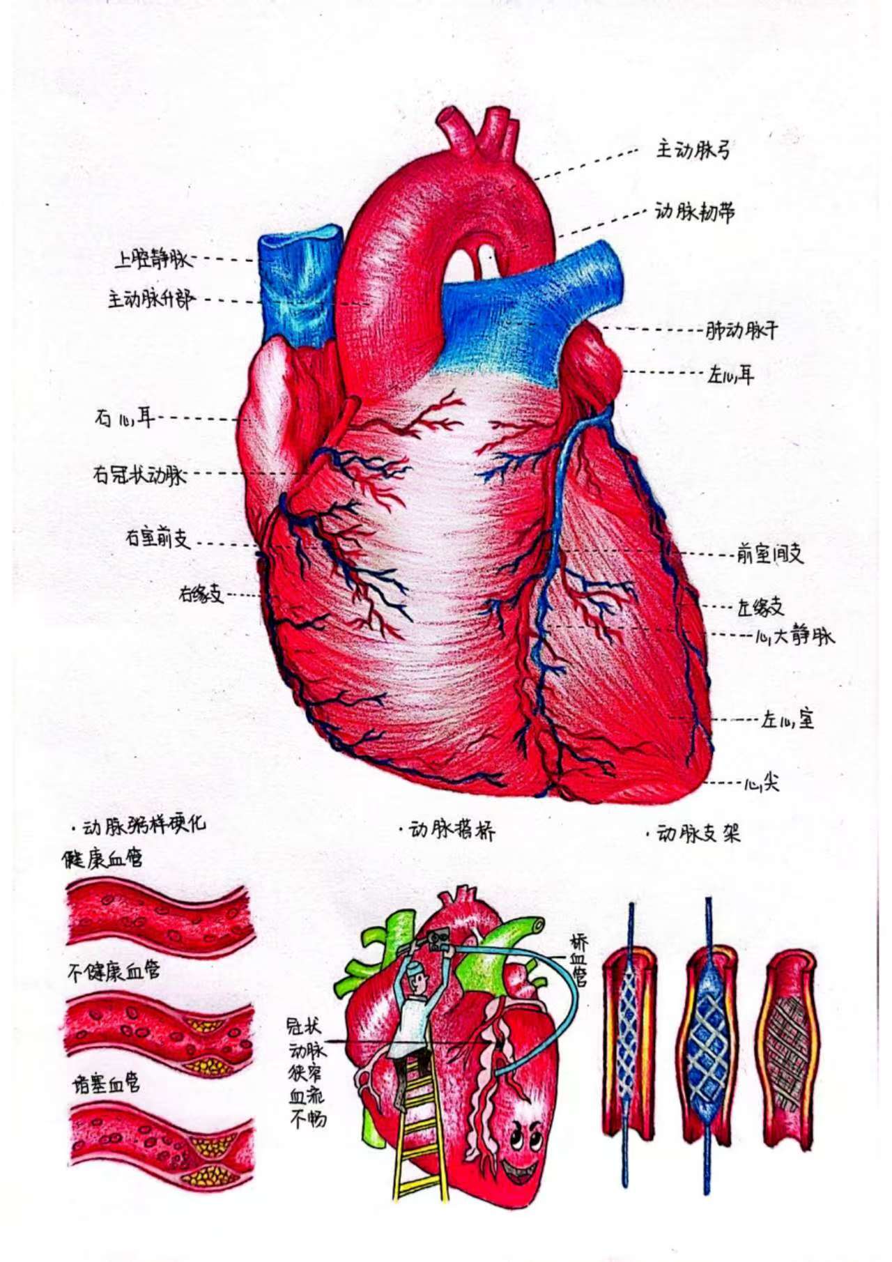 图4 2024级护理学专业9班的张雨鑫同学所绘《心路·心桥:冠脉粥样硬化与重生》荣获三等奖 图4 2024级护理学专业9班的张雨鑫同学所绘《心路·心桥:冠脉粥样硬化与重生》荣获三等奖